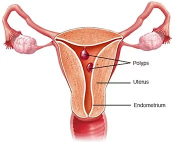 Tratamiento del sangrado uterino anormal - Los mejores ginecólogos en Brooklyn NYC