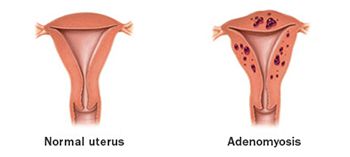 Adenomyosis Treatment - Best Gynecologists in Brooklyn NYC