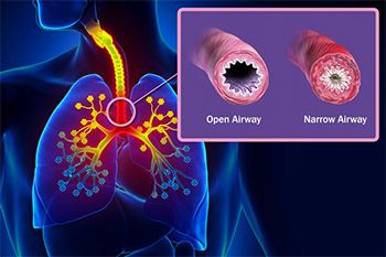 Asthma Treatment