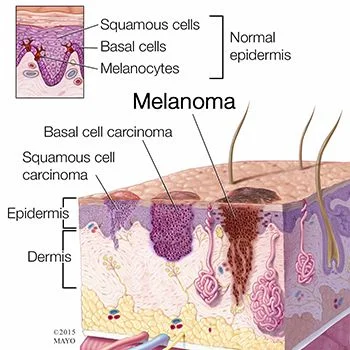 Tratamiento del carcinoma basocelular en Brooklyn