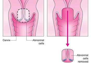 Cervical Cone Biopsy Procedure in Brooklyn NYC