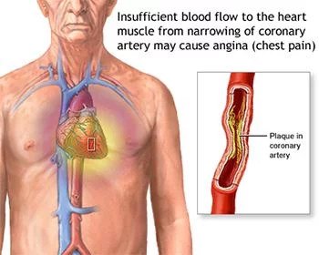 Chest Pain Treatment - Best Internal Medicine Doctors in Brooklyn NYC