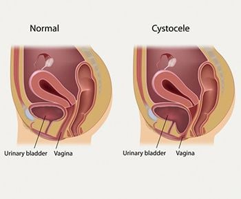 Cystocele (Anterior Prolapse) Treatment - Century Medical and Dental Center