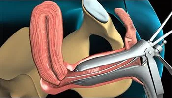 Procedimiento de biopsia endometrial en Brooklyn