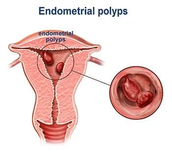 Endometrial Polyp Treatment - Best Gynecologists in Brooklyn NYC