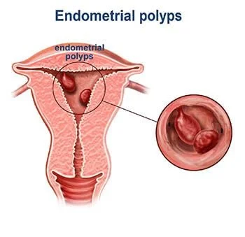 Tratamiento de pólipos endometriales - Los mejores ginecólogos en Brooklyn NYC