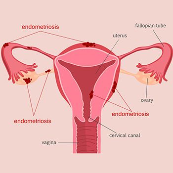 Tratamiento de la endometriosis - Los mejores ginecólogos en Brooklyn NYC