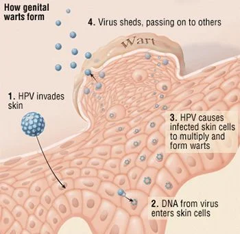 Tratamiento de las verrugas genitales - Century Medical and Dental Center