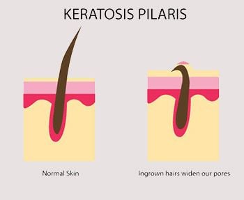 Keratosis Pilaris Treatment - Best Dermatologists in Brooklyn NYC