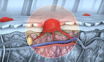 Tratamiento del melanoma - Century Medical and Dental Center