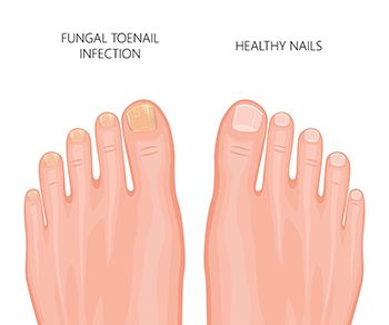 Tratamiento de hongos en las uñas - Los mejores dermatólogos de Brooklyn