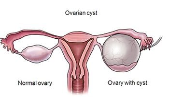 Ovary cyst symptoms