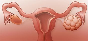 Ovarian Polyps Treatment - Best Gynecologists in Brooklyn NYC