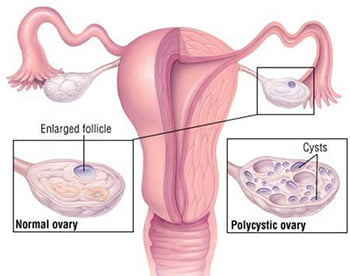 Polycystic Ovarian Syndrome Treatment - Century Medical and Dental Center