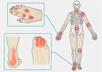 Psoriasis Treatment - Best Dermatologists in Brooklyn NYC