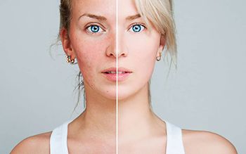 Rosacea Treatment - Best Dermatologists in Brooklyn NYC