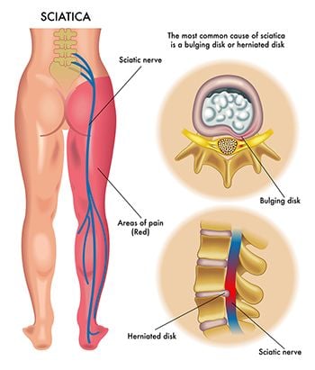 Sciatica Pain Treatment - Best Pain Doctors in Brooklyn, Manhattan, Harlem