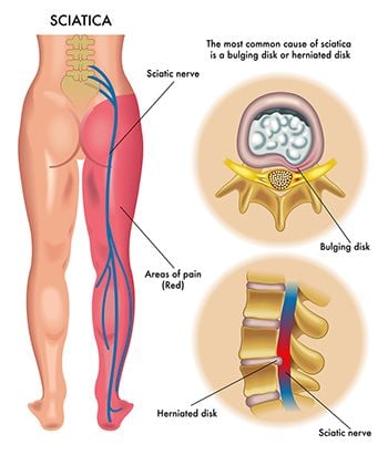 Sciatica Pain Treatment - Best Pain Management Doctors in Brooklyn