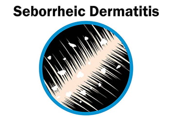 Tratamiento de la dermatitis seborreica - Century Medical &amp; Dental Center