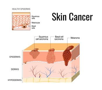 Skin Cancer Treatment - Century Medical and Dental Center NYC