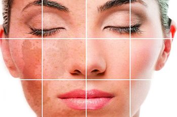 Skin Discoloration Treatment - Best Dermatologists in Brooklyn NYC