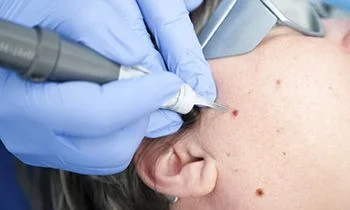 Skin Tag Removal in Flatbush NYC, Downtown Brooklyn, Gravesend