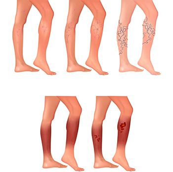 Spider Veins Treatment in Brooklyn New York