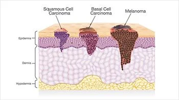 Tratamiento del carcinoma de células escamosas - Los mejores dermatólogos en Brooklyn NY