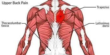 Tratamiento del dolor de espalda superior - Los mejores fisioterapeutas en Brooklyn