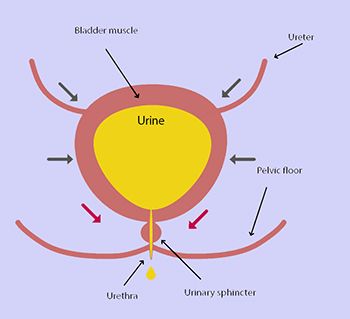 Urinary incontinence in women