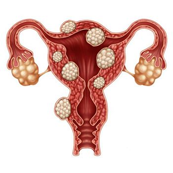 Uterine Fibroids Treatment - Gynecologists in Brooklyn