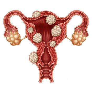 Tratamiento de los fibromas uterinos - Ginecólogos en Brooklyn