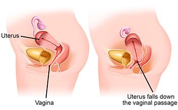 Uterine Prolapse Treatment - Century Medical and Dental Center