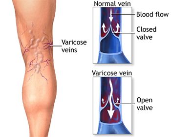 Tratamiento de venas varicosas - Los mejores médicos de la vena en Brooklyn NYC