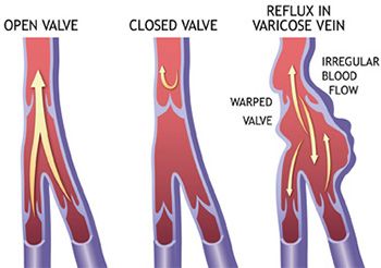 Venous Insufficiency Treatment - Best Vein Doctors in Brooklyn NYC