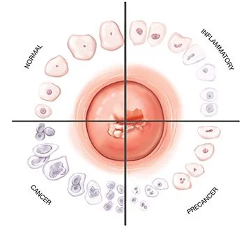 Tratamiento de la citología vaginal anormal en Brooklyn y Manhattan, NY