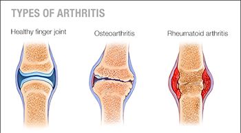 Tratamiento de la artritis y la osteoartritis en Brooklyn NYC