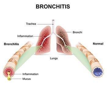 Bronchitis Treatment - Best Internal Medicine Doctors in Brooklyn NYC