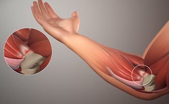 Elbow Pain Treatment - Best Physical Therapists in Brooklyn NYC