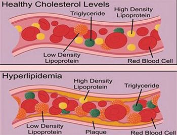 High Cholesterol and Triglycerides Treatment in Brooklyn NYC