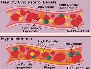 High Cholesterol Treatment NYC (Brooklyn, Manhattan, Harlem)
