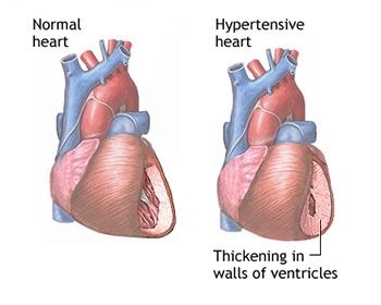 Hypertension Treatment - Best Internal Medicine Doctors in Brooklyn NYC