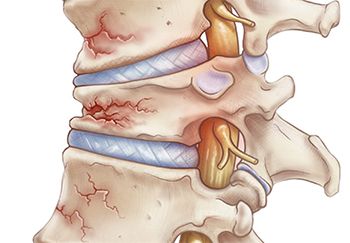 Osteoporosis Treatment - Internal Medicine Doctors in Brooklyn NYC