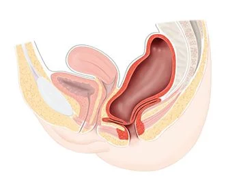 Tratamiento Rectocele - Los mejores ginecólogos en Brooklyn