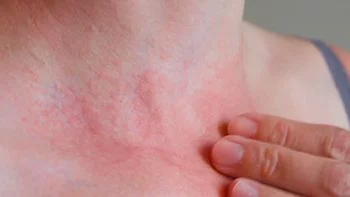 Red spots on skin: causes, treatment and when to worry