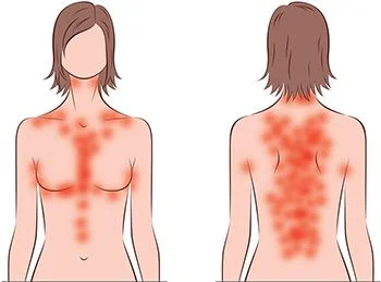 Tratamiento de erupciones cutáneas - El mejor dermatólogo en Brooklyn NYC