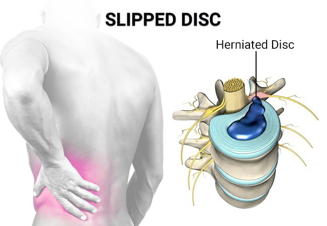 Slipped (Herniated) Disc - Causes and Symptoms