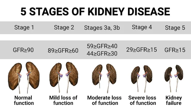 5 Stages of Kidney Disease