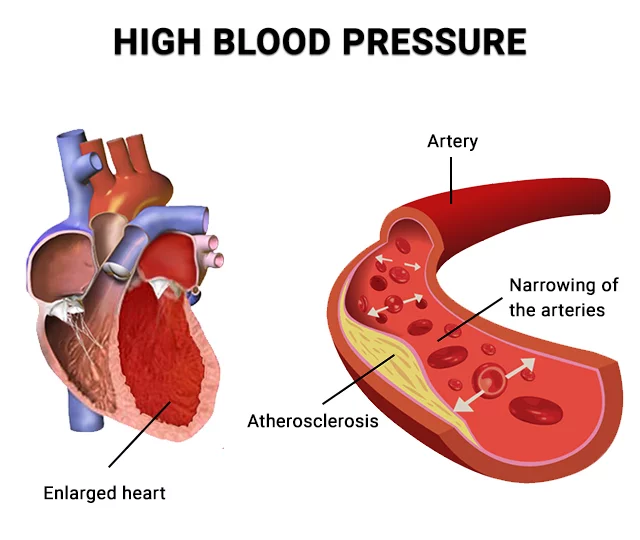 High Blood Pressure