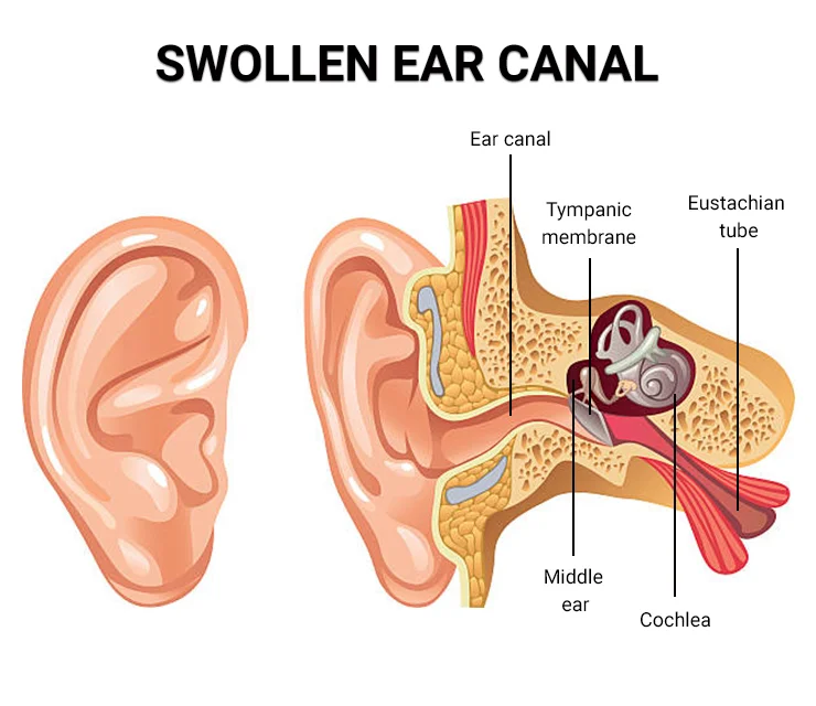 Swollen Ear Canal